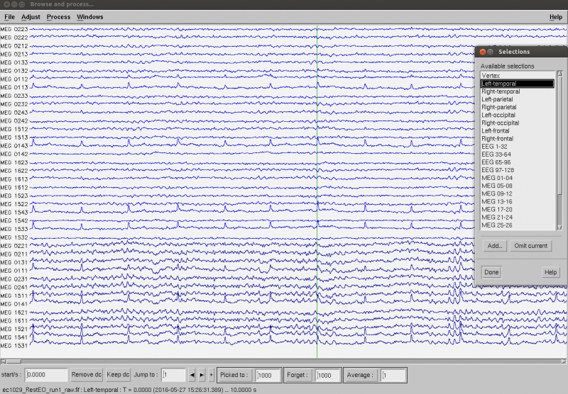 Ecg artifact.png